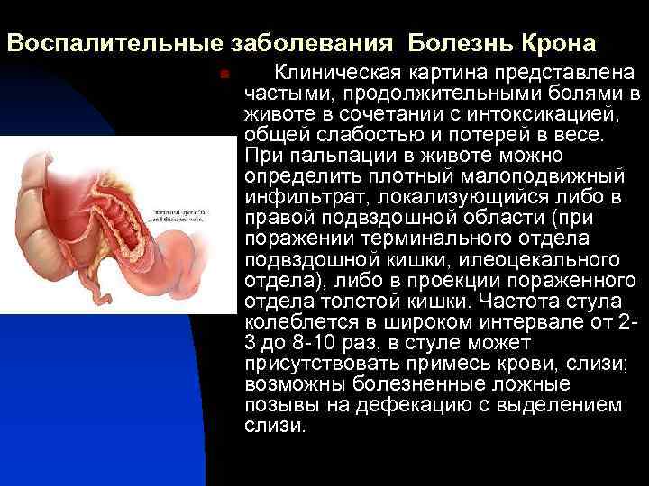 Воспалительные заболевания Болезнь Крона n Клиническая картина представлена частыми, продолжительными болями в животе в