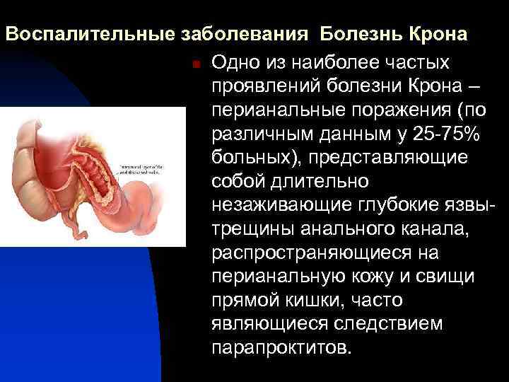 Воспалительные заболевания Болезнь Крона n Одно из наиболее частых проявлений болезни Крона – перианальные