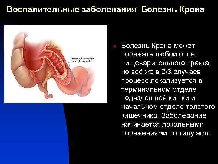 Воспалительные заболевания Болезнь Крона n Болезнь Крона может поражать любой отдел пищеварительного тракта, но