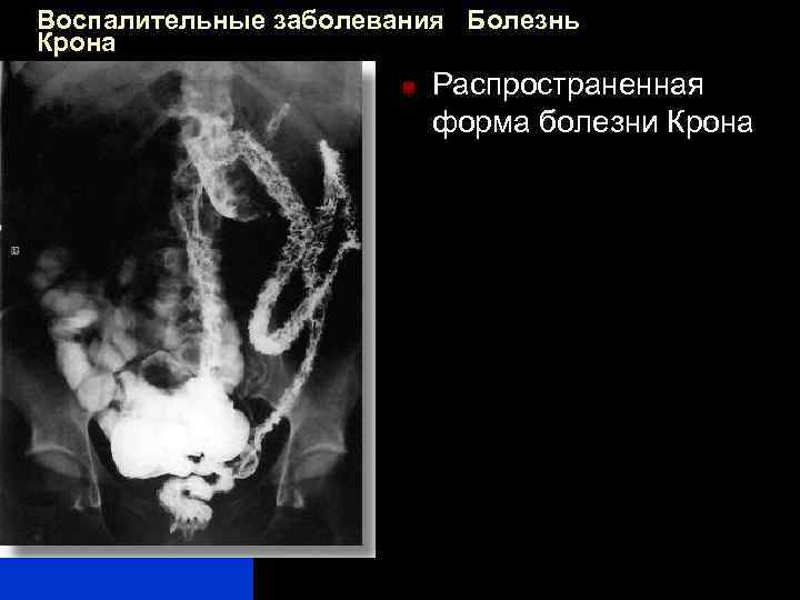 Воспалительные заболевания Болезнь Крона n Распространенная форма болезни Крона 