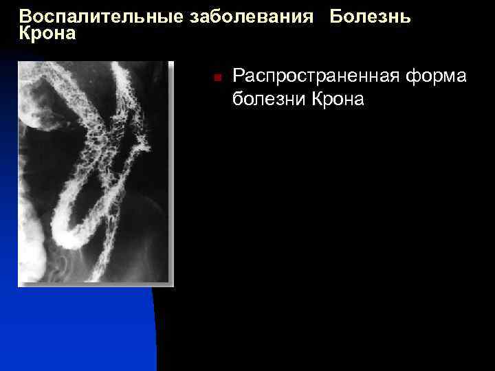 Воспалительные заболевания Болезнь Крона n Распространенная форма болезни Крона 