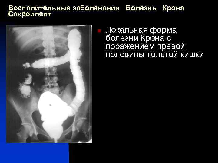 Воспалительные заболевания Болезнь Крона Сакроилеит n Локальная форма болезни Крона с поражением правой половины
