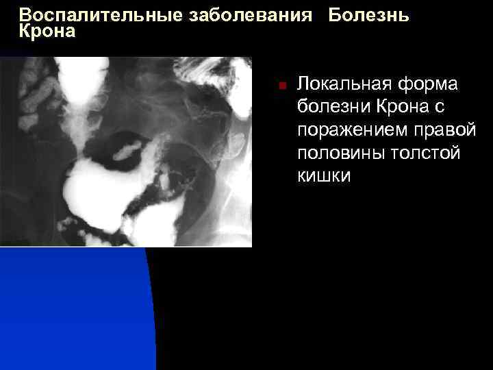 Воспалительные заболевания Болезнь Крона n Локальная форма болезни Крона с поражением правой половины толстой