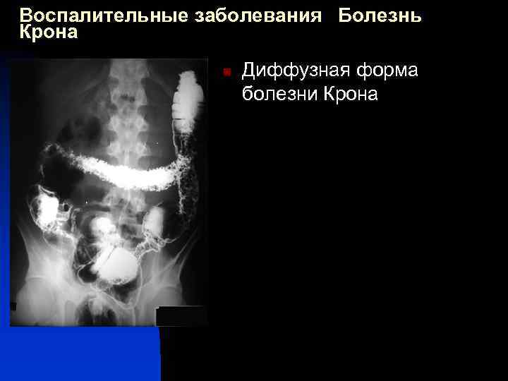 Воспалительные заболевания Болезнь Крона n Диффузная форма болезни Крона 