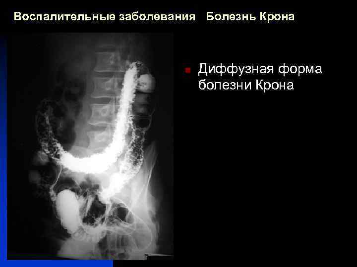 Воспалительные заболевания Болезнь Крона n Диффузная форма болезни Крона 
