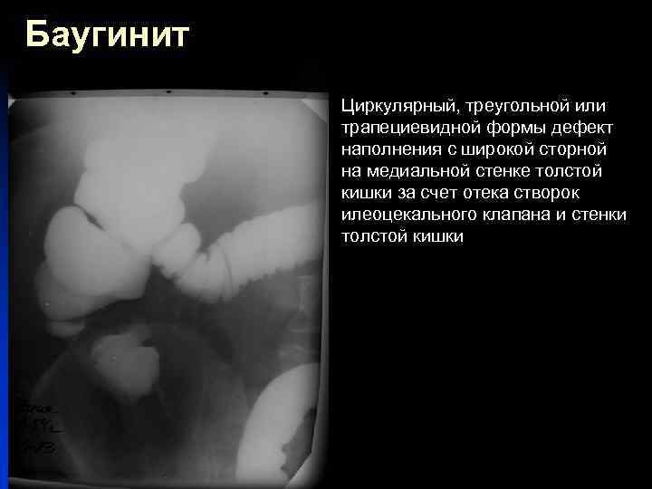 Баугинит n Циркулярный, треугольной или трапециевидной формы дефект наполнения с широкой сторной на медиальной