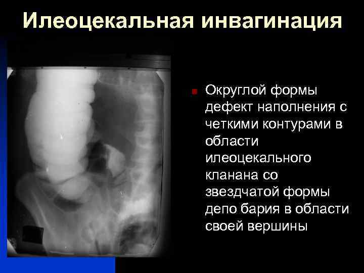 Илеоцекальная инвагинация n Округлой формы дефект наполнения с четкими контурами в области илеоцекального кланана