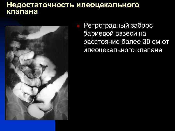 Недостаточность илеоцекального клапана n Ретроградный заброс бариевой взвеси на расстояние более 30 см от