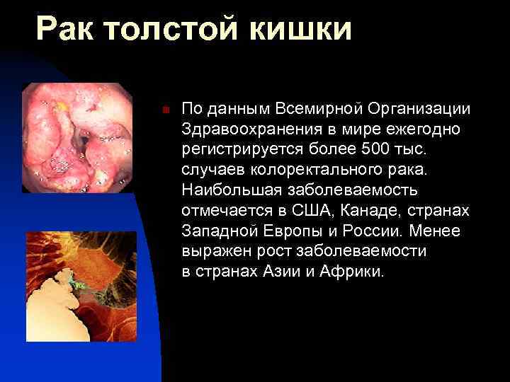 Рак толстой кишки n По данным Всемирной Организации Здравоохранения в мире ежегодно регистрируется более
