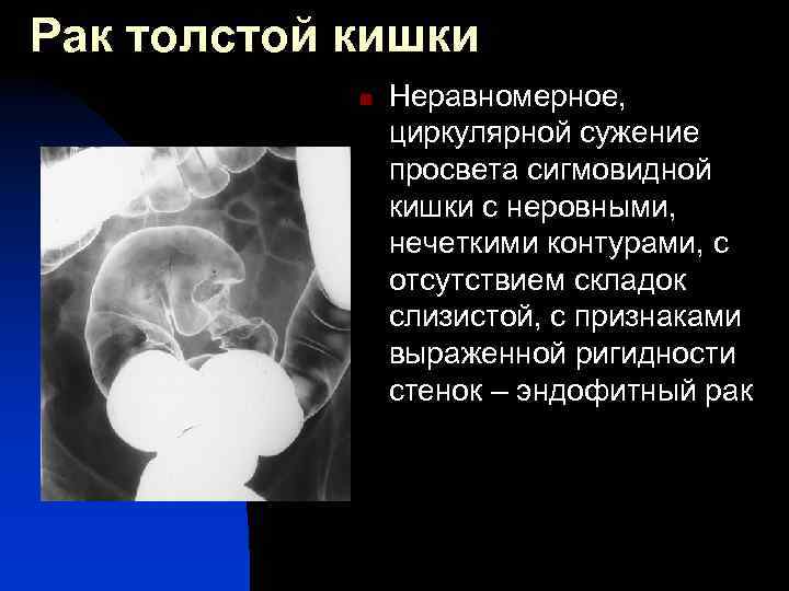 Рак толстой кишки n Неравномерное, циркулярной сужение просвета сигмовидной кишки с неровными, нечеткими контурами,