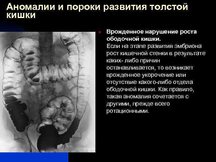 Аномалии и пороки развития толстой кишки n Врожденное нарушение роста ободочной кишки. Если на