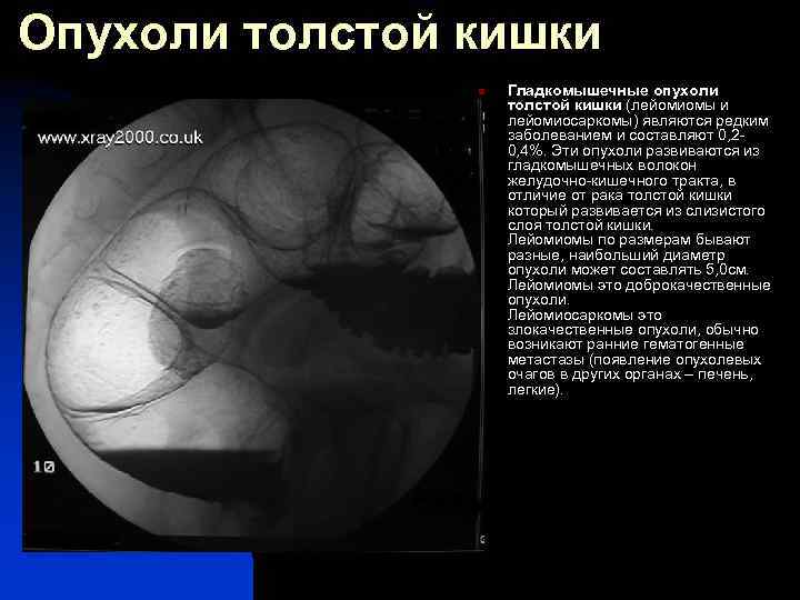 Опухоли толстой кишки n Гладкомышечные опухоли толстой кишки (лейомиомы и лейомиосаркомы) являются редким заболеванием
