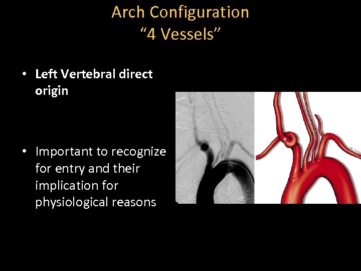 Arch Configuration “ 4 Vessels” • Left Vertebral direct origin • Important to recognize