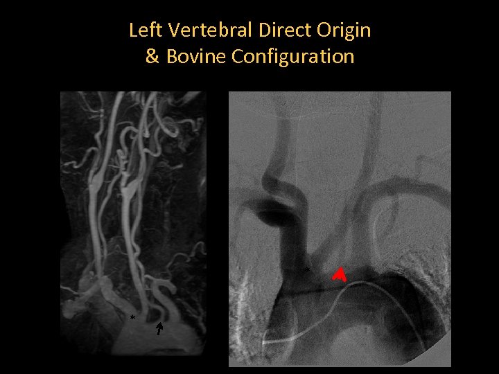 Left Vertebral Direct Origin & Bovine Configuration * * A 