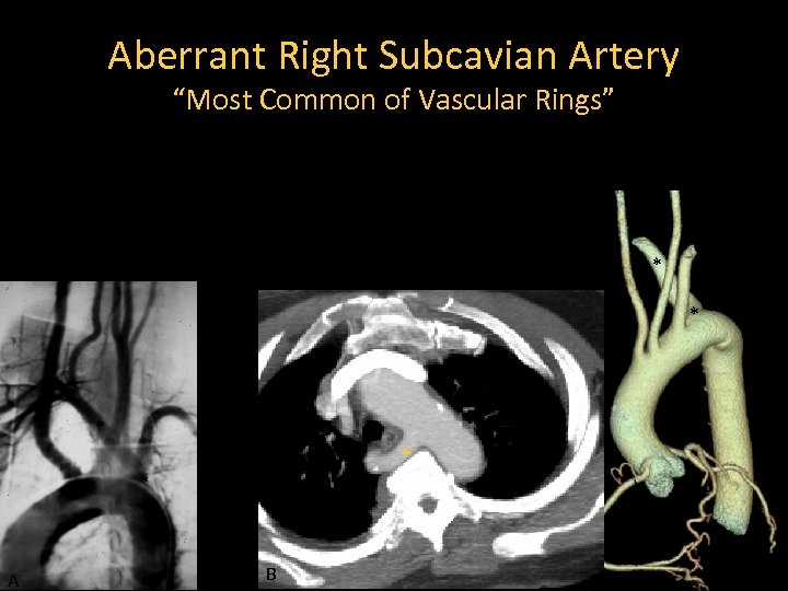 Aberrant Right Subcavian Artery “Most Common of Vascular Rings” * * * A B