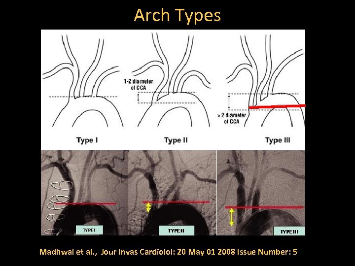 Arch Types Madhwal et al. , Jour Invas Cardiolol: 20 May 01 2008 Issue