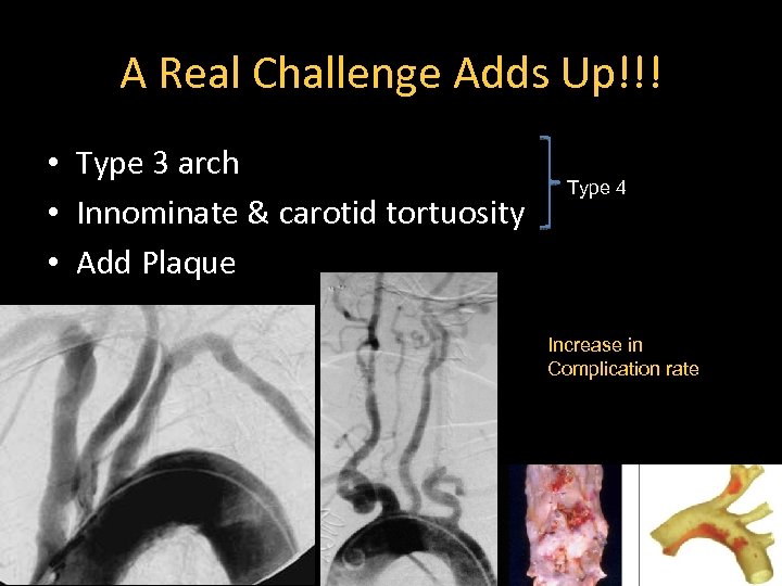 A Real Challenge Adds Up!!! • Type 3 arch • Innominate & carotid tortuosity