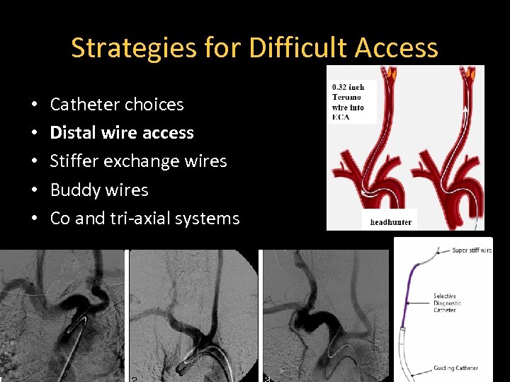 Strategies for Difficult Access • • • Catheter choices Distal wire access Stiffer exchange