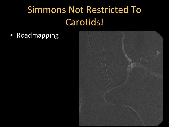 Simmons Not Restricted To Carotids! • Roadmapping 