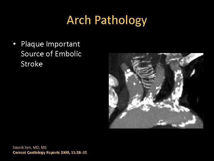 Arch Pathology • Plaque Important Source of Embolic Stroke Souvik Sen, MD, MS Current