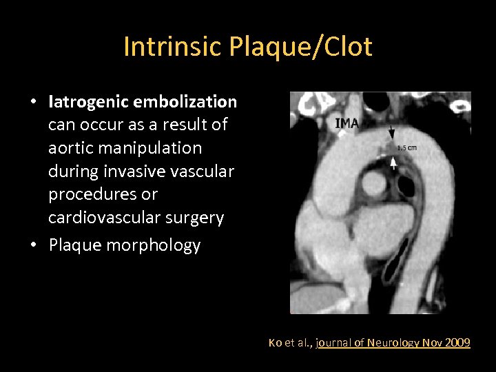 Intrinsic Plaque/Clot • Iatrogenic embolization can occur as a result of aortic manipulation during