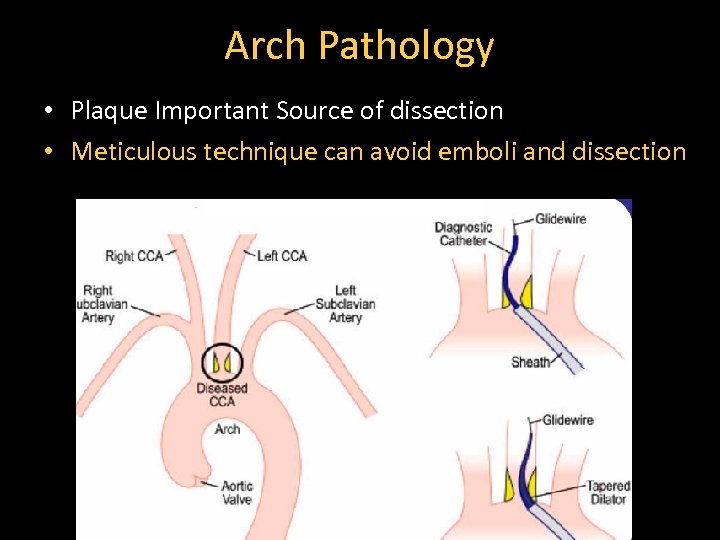 Arch Pathology • Plaque Important Source of dissection • Meticulous technique can avoid emboli