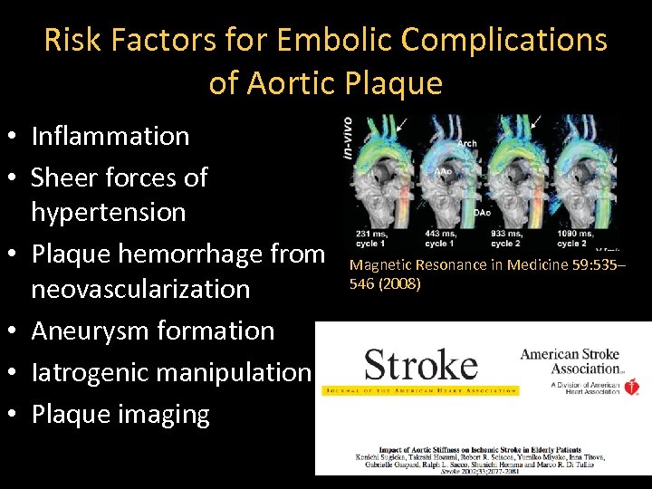 Risk Factors for Embolic Complications of Aortic Plaque • Inflammation • Sheer forces of