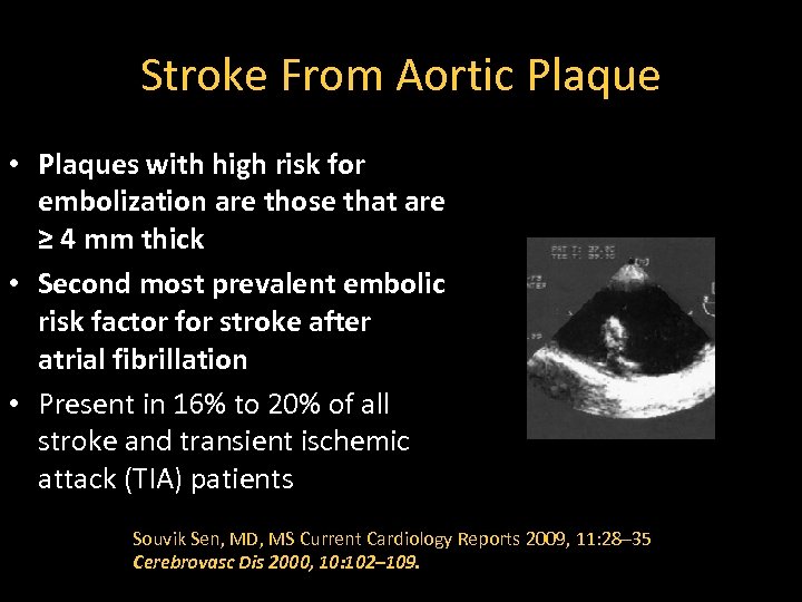 Stroke From Aortic Plaque • Plaques with high risk for embolization are those that