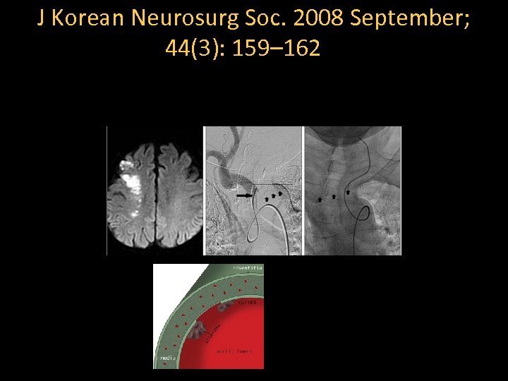 J Korean Neurosurg Soc. 2008 September; 44(3): 159– 162 