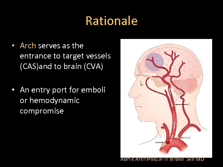 Rationale • Arch serves as the entrance to target vessels (CAS)and to brain (CVA)