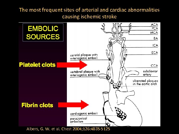 The most frequent sites of arterial and cardiac abnormalities causing ischemic stroke Albers, G.