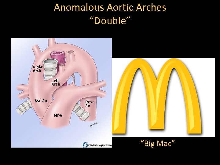 Anomalous Aortic Arches “Double” “Big Mac” 