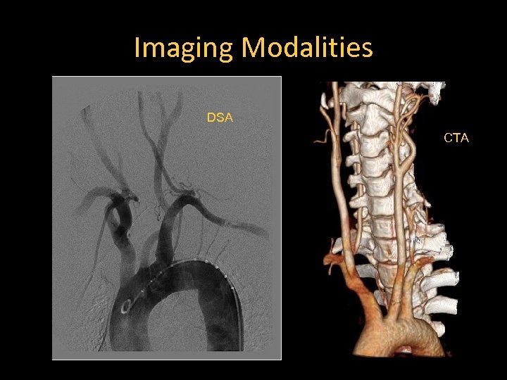 Imaging Modalities DSA CTA 