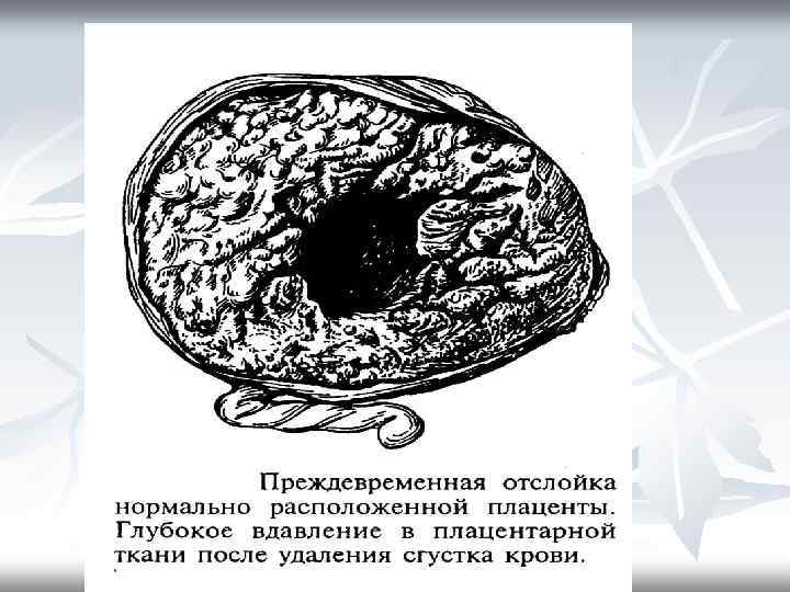 Нормально расположенная плацента. Жэпителиохориальные плаценты. Отслойка нормально расположенной плаценты. Отслойка нормальной плаценты преждевременная. Преждевременное отслоение нормально расположенной плаценты.