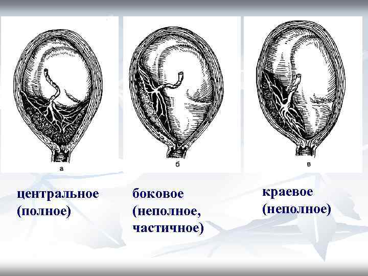 центральное (полное) боковое (неполное, частичное) краевое (неполное) 