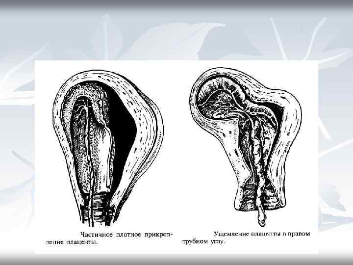 Плацента на рубце матки