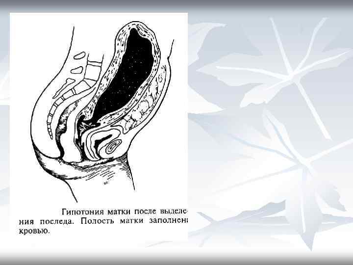 Матка после родов. Акушерские кровотечения гипотония матки. Гипотония и атония матки. Атония матки в послеродовом периоде. Атония и гипотония матик.