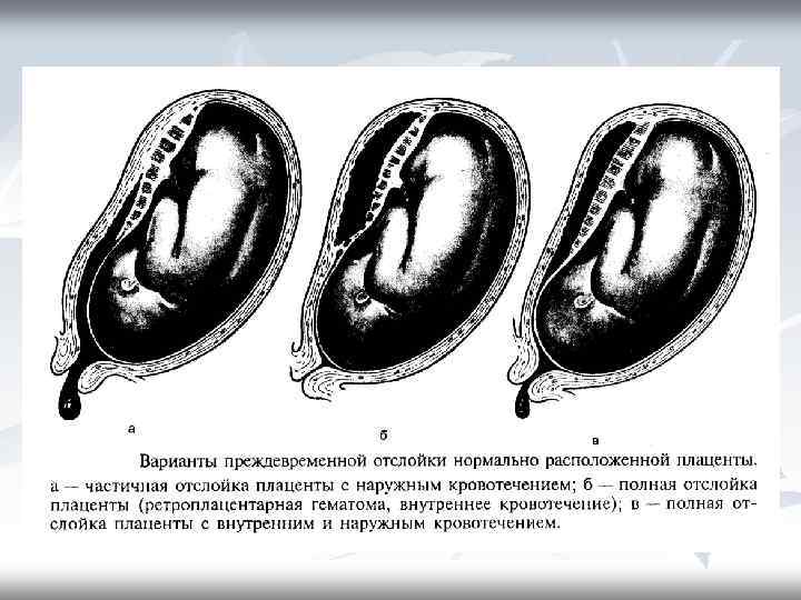 Преждевременная отслойка нормально расположенной плаценты. Преждевременная отслойка плаценты формы. Отслойка нормальной расположенной плаценты. Тотальная и частичная отслойка плаценты. Ретроплацентарная отслойка плаценты.