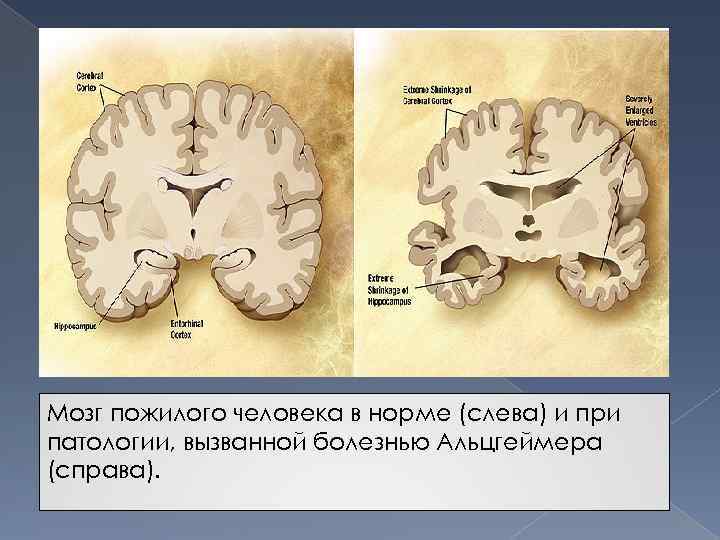 Мозг пожилого человека в норме (слева) и при патологии, вызванной болезнью Альцгеймера (справа). 