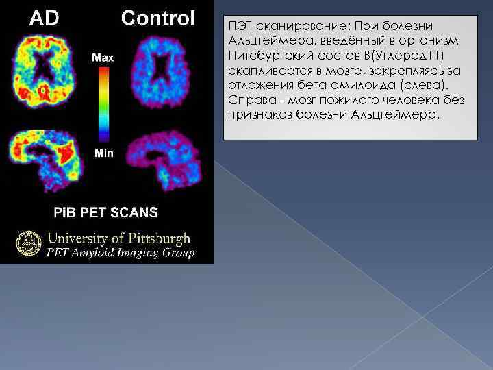 ПЭТ-сканирование: При болезни Альцгеймера, введённый в организм Питсбургский состав B(Углерод 11) скапливается в мозге,