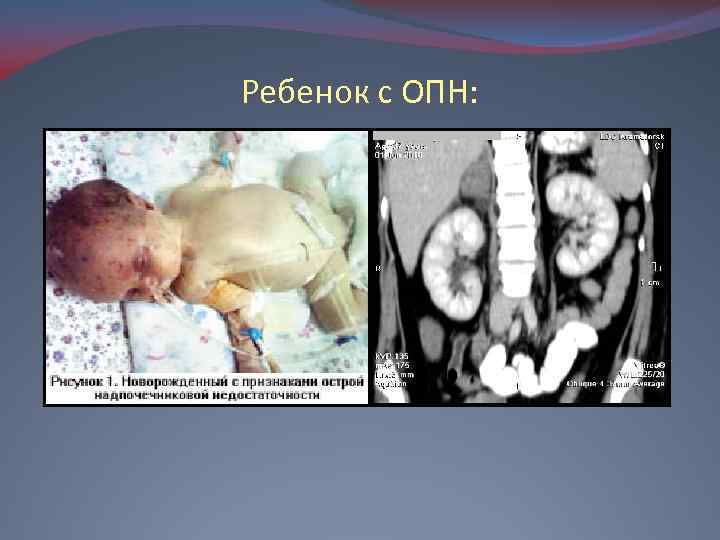 Ребенок с ОПН: 