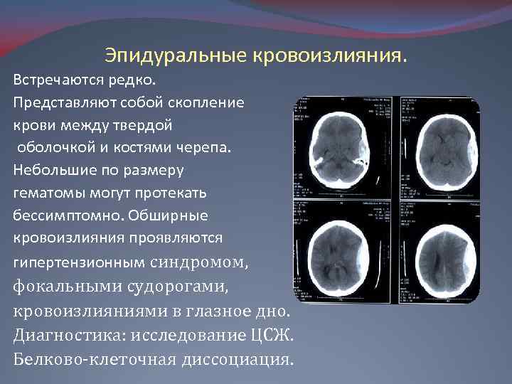 Субдуральное кровоизлияние это. Субдуральная и эпидуральная гематома. Эпидуральные кровоизлияния. Эпидуральное кровоизлияние кт. Эпидуральная гематома локализация.