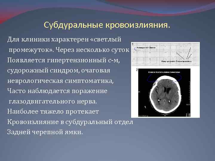 Субдуральное кровоизлияние это. Субдуральная гематома симптоматика. Субдуральная гематома новорожденных.