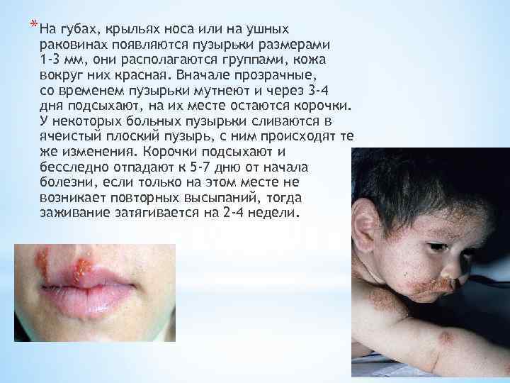 * На губах, крыльях носа или на ушных раковинах появляются пузырьки размерами 1 -3