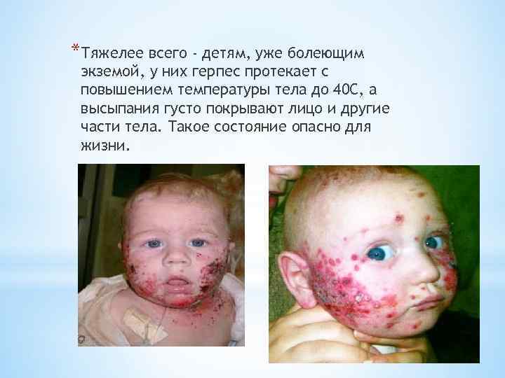 *Тяжелее всего - детям, уже болеющим экземой, у них герпес протекает с повышением температуры