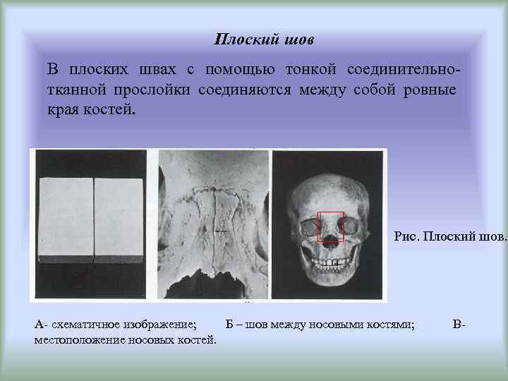 Плоский шов В плоских швах с помощью тонкой соединительнотканной прослойки соединяются между собой ровные