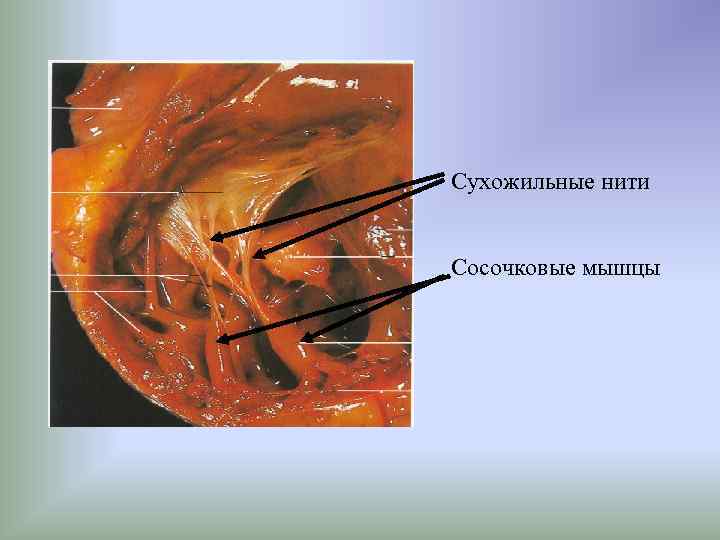 Хорда левого. Створчатые клапаны сердца сосочковые мышцы и сухожильные нити. Папиллярные и сосочковые мышцы. Сосочковые мышцы и сухожильные хорды нити. Строение сердца сухожильные нити.