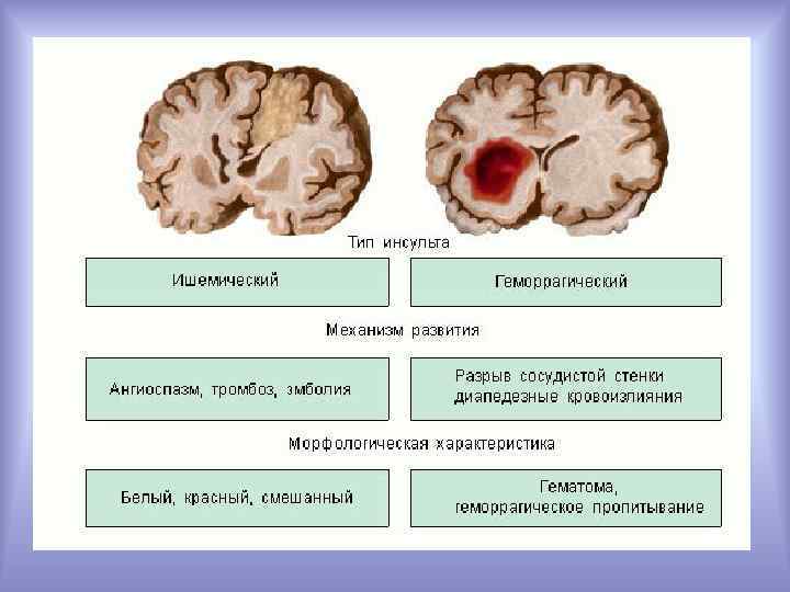 Инсульт правая сторона мозга последствия. Типы ишемического инсульта. Ишемический инсульт в коре головного мозга. Ишемический инсульт мозга патанатомия. Виды инсультов головного мозга геморрагический и ишемический.