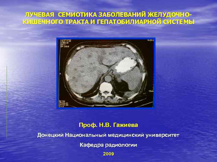 ЛУЧЕВАЯ СЕМИОТИКА ЗАБОЛЕВАНИЙ ЖЕЛУДОЧНОКИШЕЧНОГО ТРАКТА И ГЕПАТОБИЛИАРНОЙ СИСТЕМЫ Проф. Н. В. Гажиева Донецкий Национальный