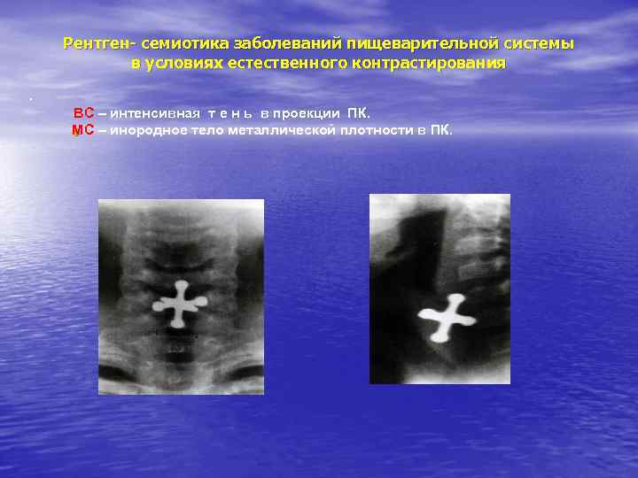 Рентген- семиотика заболеваний пищеварительной системы в условиях естественного контрастирования. ВС – интенсивная т е